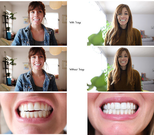 clear-braces-before-and-after