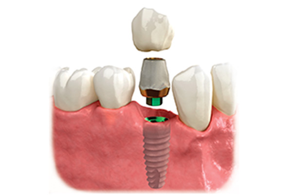 dental-implant